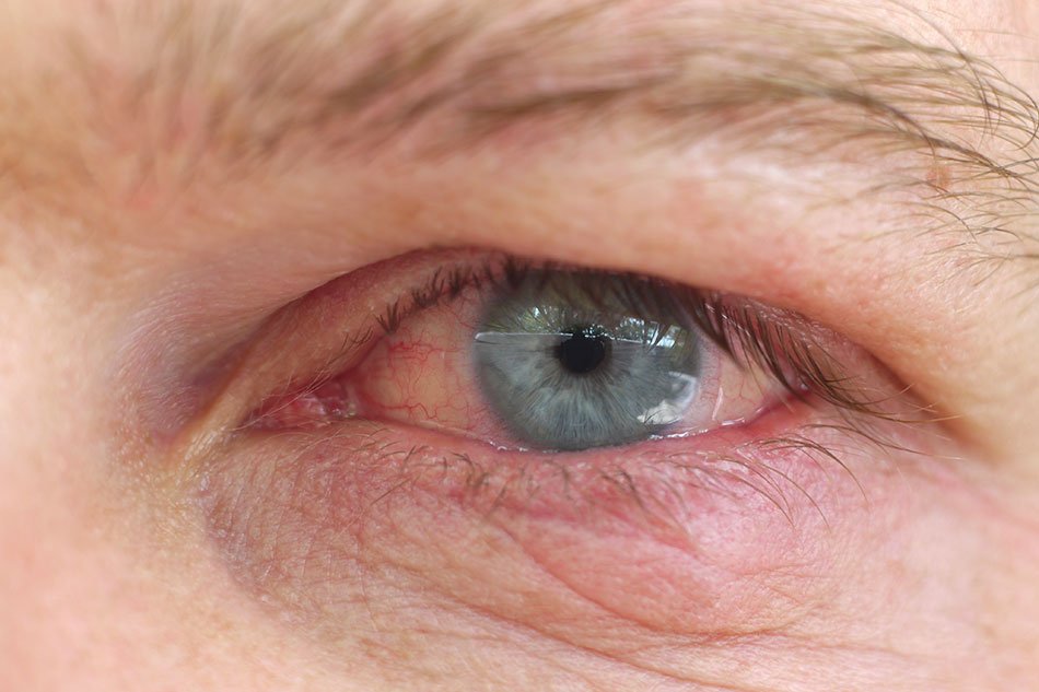 How To Clean Colored Contacts Without Damaging Comfort Or Clarity