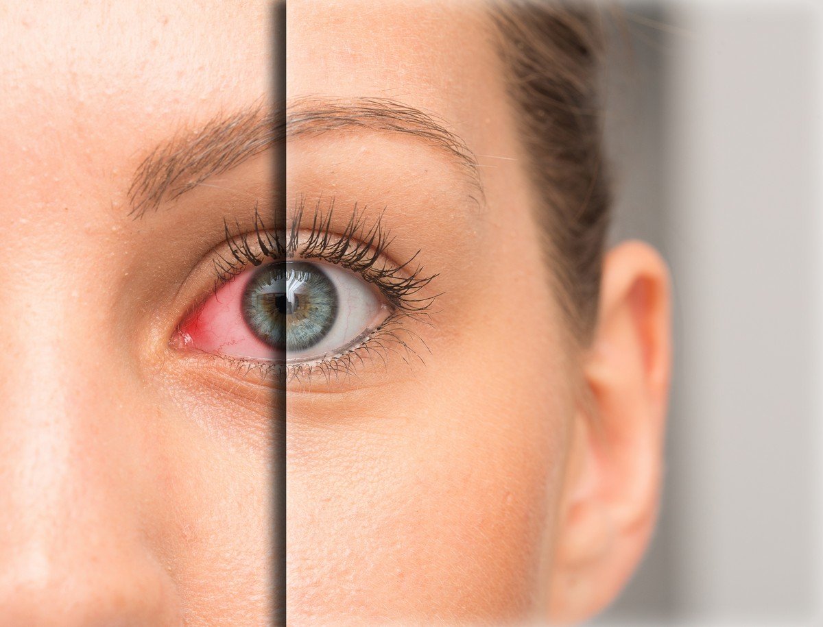 Combat Contact Irritation With These 7 Easy Remedies for Dry Eyes