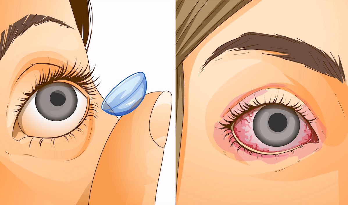 How to Prevent Protein Build up on Contact Lenses?